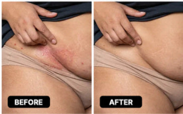 Reference before-and-after photograph for apron belly folds; not a verified Lomovia result
