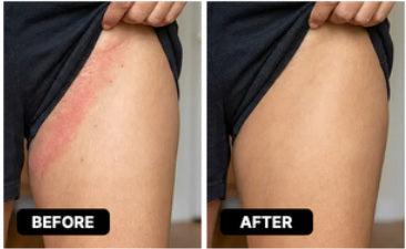 Reference before-and-after photograph for groin and inner thighs; not a verified Lomovia result