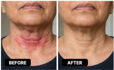 Reference before-and-after photograph for neck folds; not a verified Lomovia result