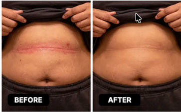 Reference before-and-after photograph for stomach folds; not a verified Lomovia result