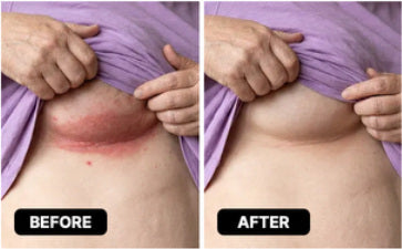 Reference before-and-after photograph for Under-breast folds; not a verified Lomovia result