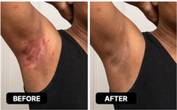 Reference before-and-after photograph for underarms; not a verified Lomovia result